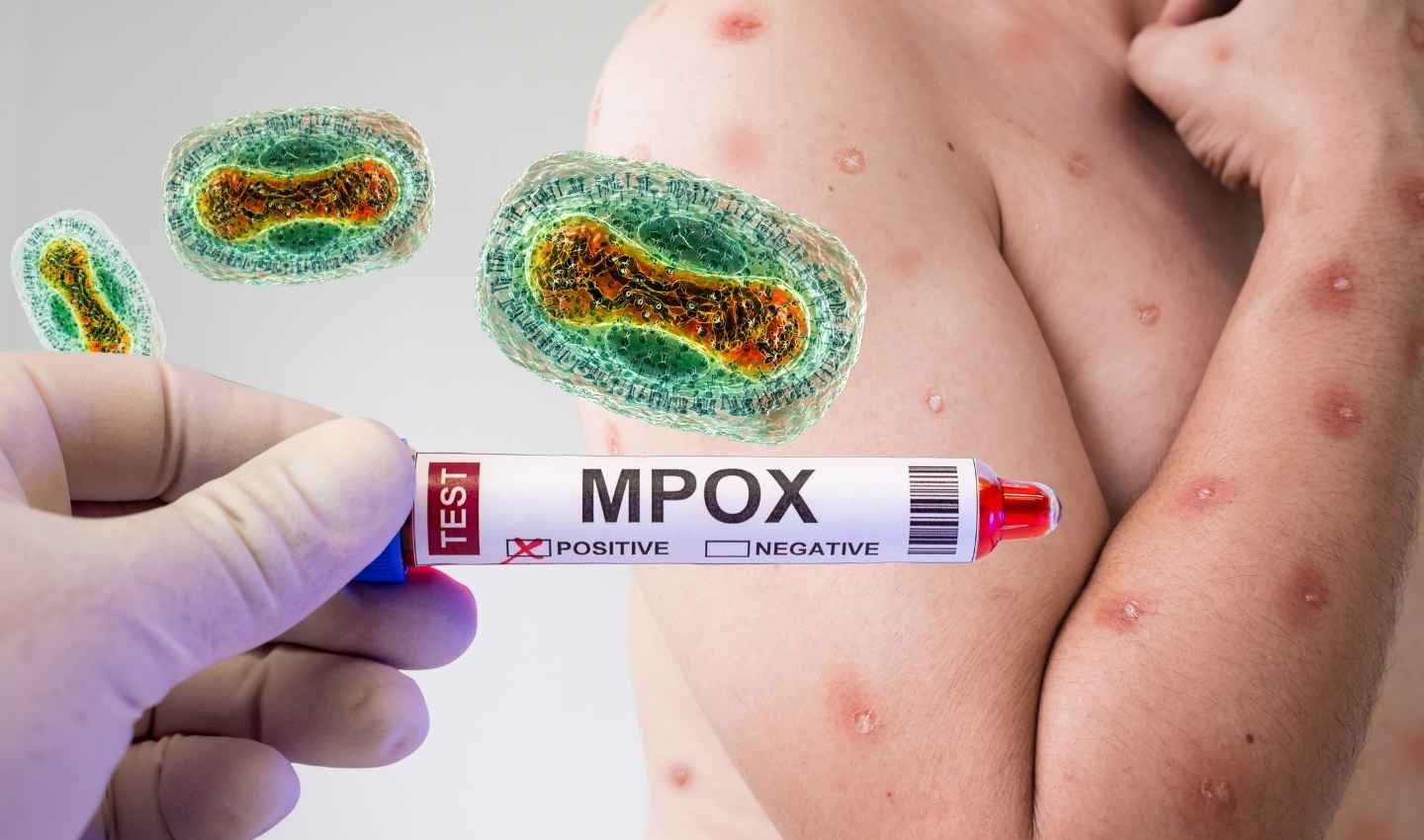 mpox o viruela del mono causa sintoma diagnostico tratamiento