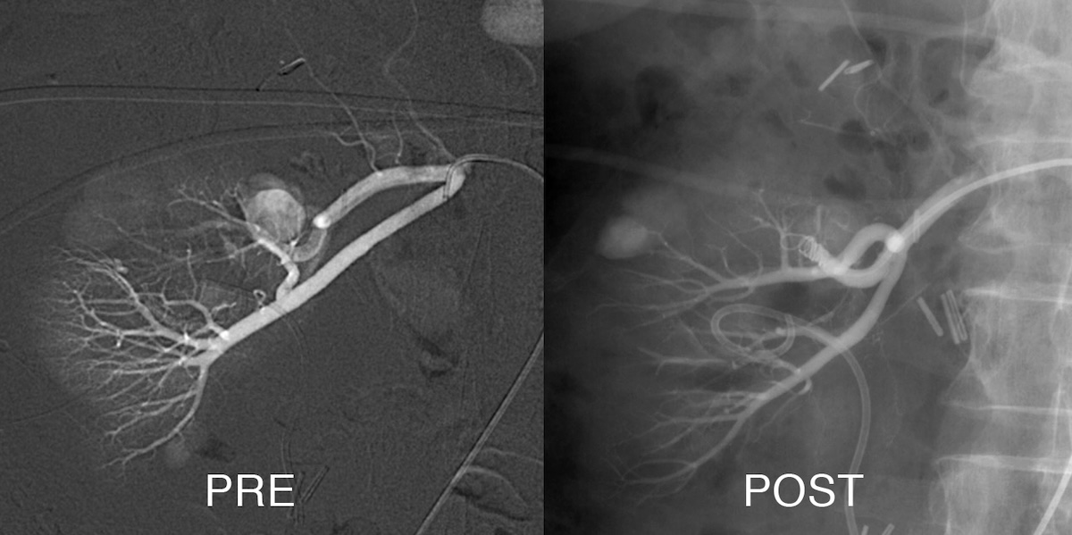 Aneurisma de arteria renal tratado con embolización selectiva