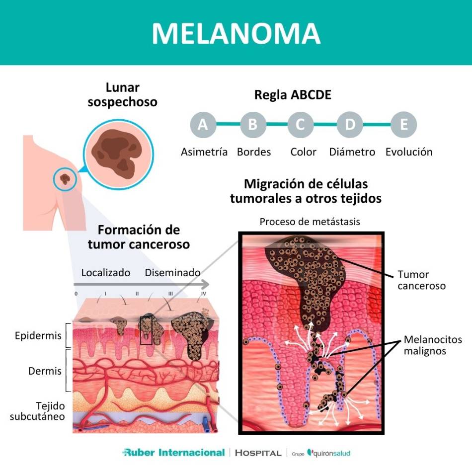 Melanoma