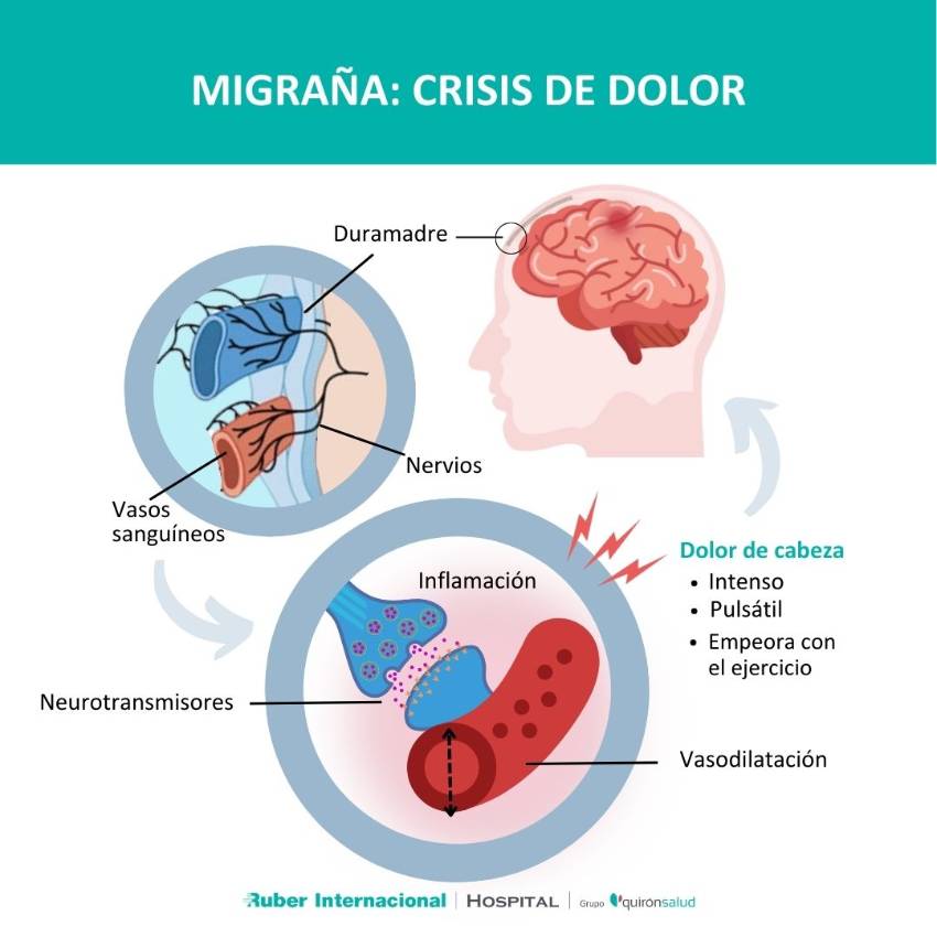 Dolor de cabeza de la migraña