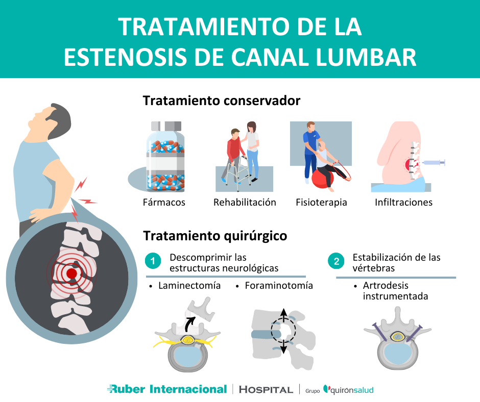 Tratamiento de la Estenosis de canal lumbar